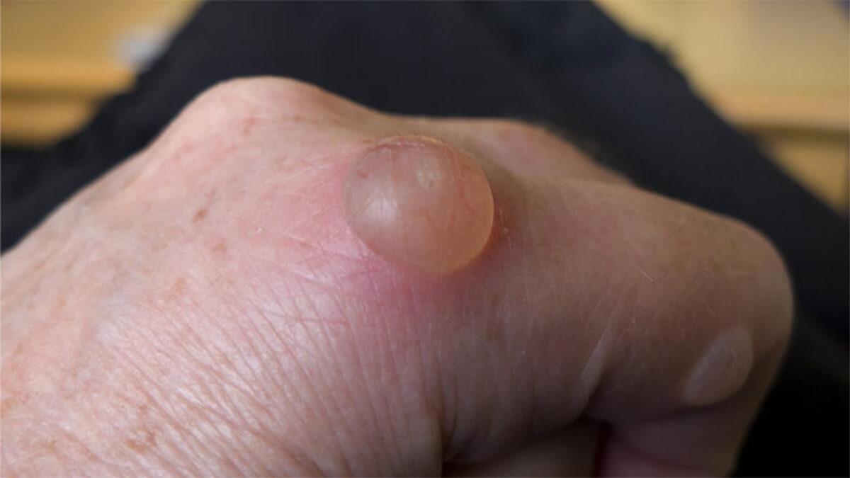 Vücudumuzda Su Toplayan Bir Yeri Neden Patlamamamız Gerektiğini Öğrenince Bir Daha O Bölgeye Dokunmayacaksınız