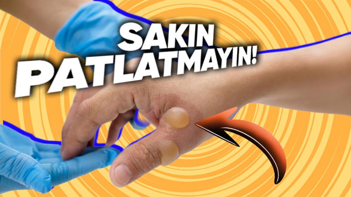 Vücudumuzda Su Toplayan Bir Yeri Neden Patlamamamız Gerektiğini Öğrenince Bir Daha O Bölgeye Dokunmayacaksınız