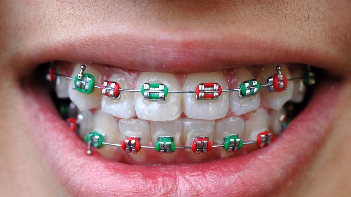 Diş Tellerinde Plastik Yerine Metal Kullanılmasının Haklı Bulacağınız Sebebi