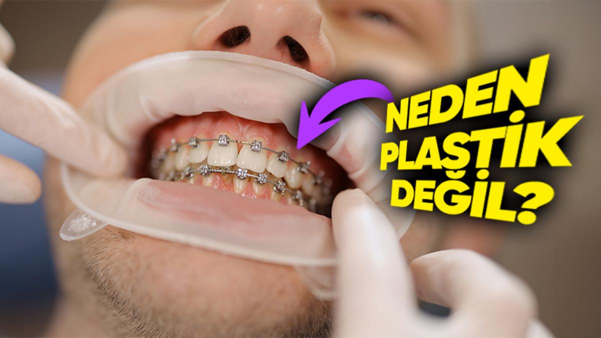 Diş Tellerinde Plastik Yerine Metal Kullanılmasının Haklı Bulacağınız Sebebi