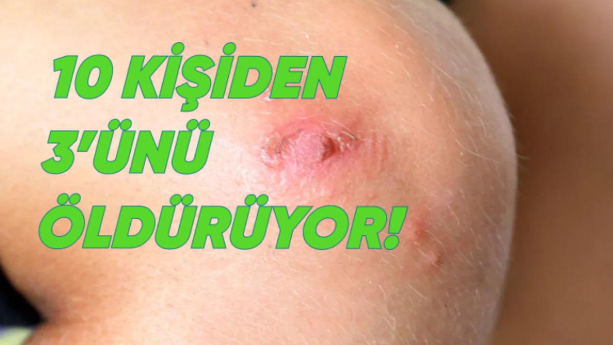 Japonya, Et yiyen Bakteri İstilâsı Altında: Ölüm Riski Çok Yüksek!