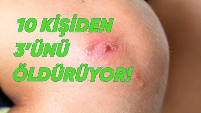 Japonya, Et yiyen Bakteri İstilâsı Altında: Ölüm Riski Çok Yüksek!