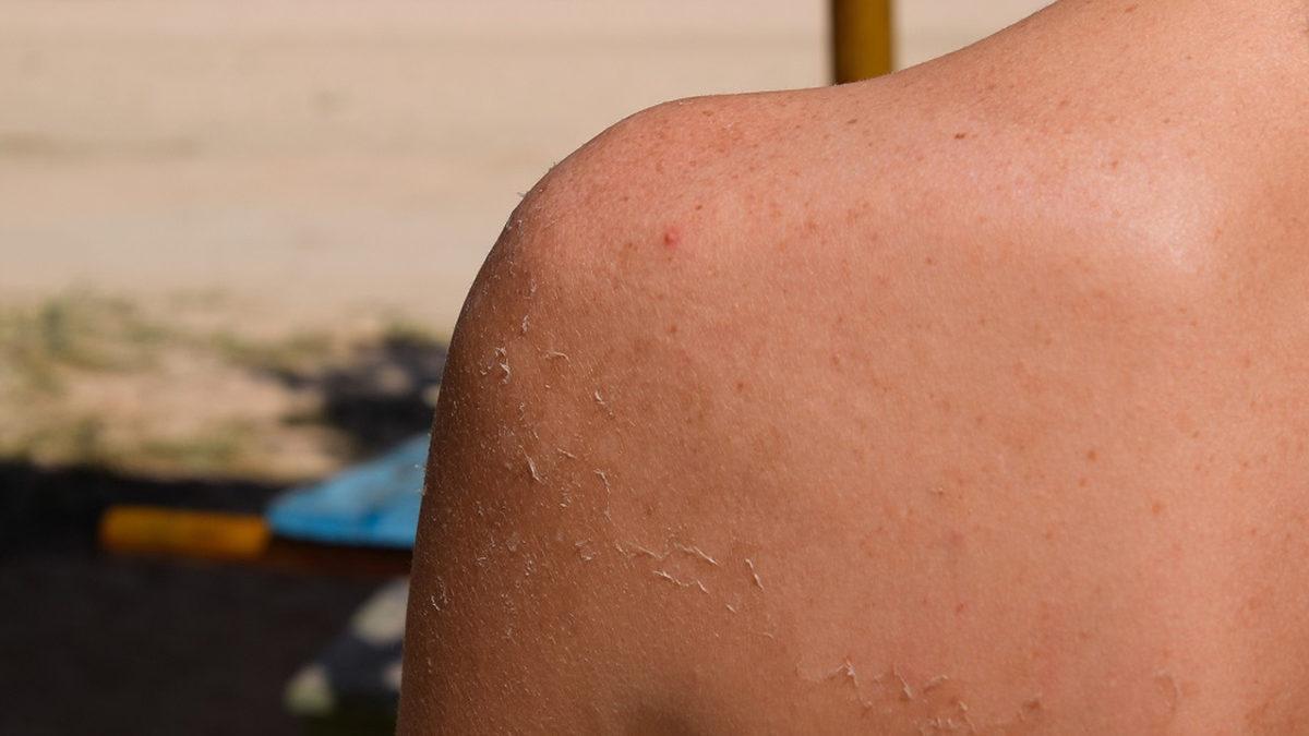 Güneşte Yandıktan Sonra Cildimiz Neden Soyuluyor? Deriyi Kendimizin Kaldırması Tehlikeli Bir Hareket mi?