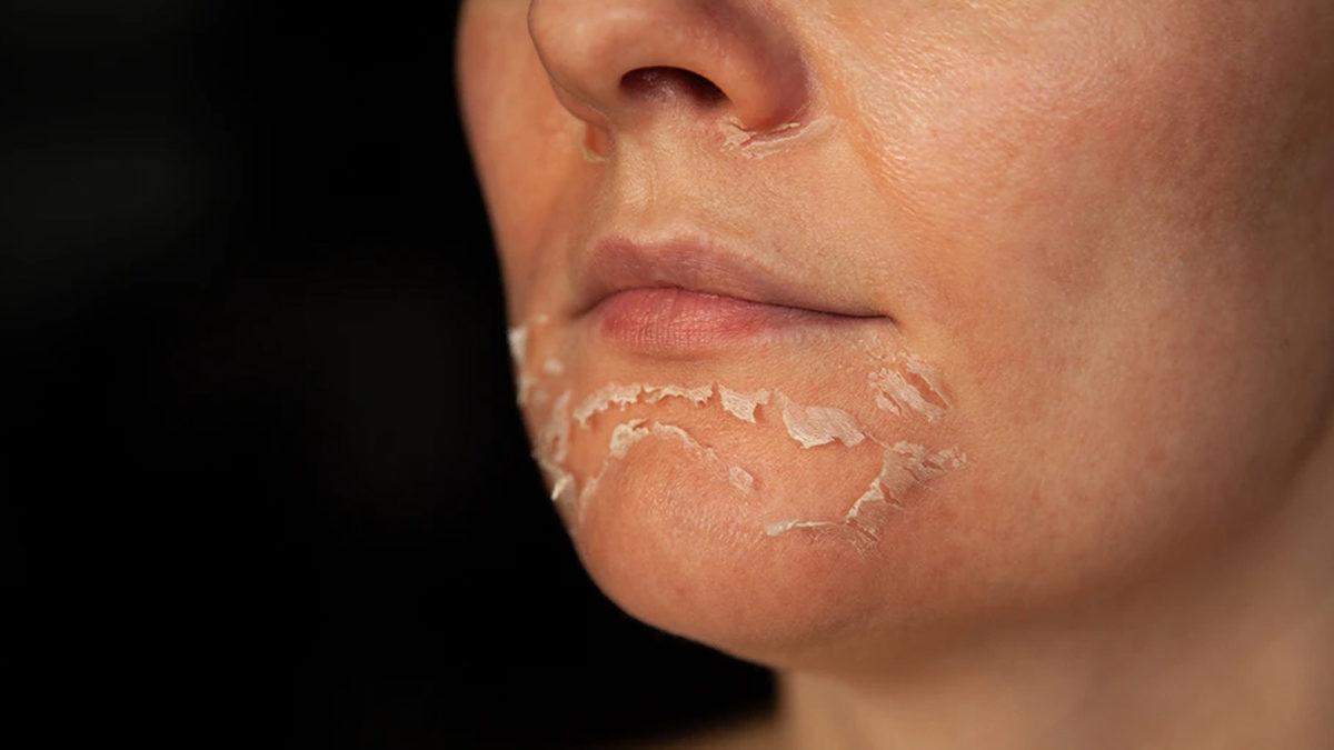 Güneşte Yandıktan Sonra Cildimiz Neden Soyuluyor? Deriyi Kendimizin Kaldırması Tehlikeli Bir Hareket mi?