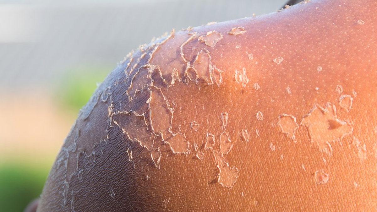 Güneşte Yandıktan Sonra Cildimiz Neden Soyuluyor? Deriyi Kendimizin Kaldırması Tehlikeli Bir Hareket mi?