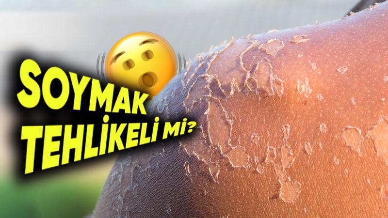 Güneşte Yandıktan Sonra Cildimiz Neden Soyuluyor? Deriyi Kendimizin Kaldırması Tehlikeli Bir Hareket mi?