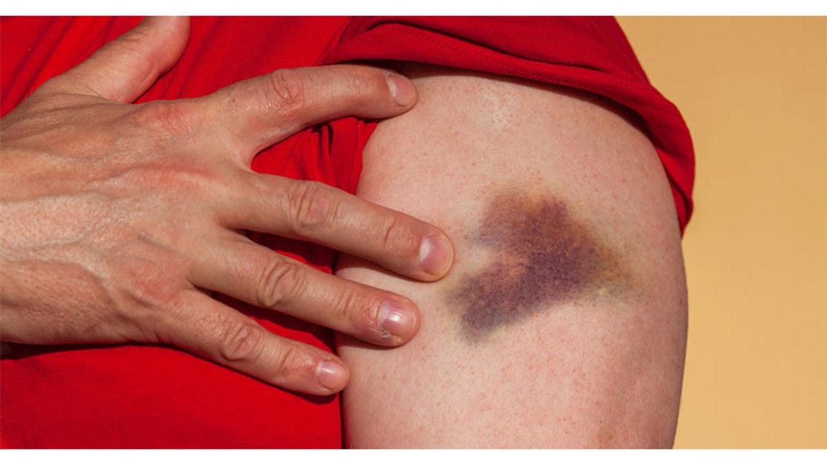 Cildimizdeki Morluklar İyileşirken Ortaya Farklı Renkler Çıkmasının Çok Mantıklı Sebebi
