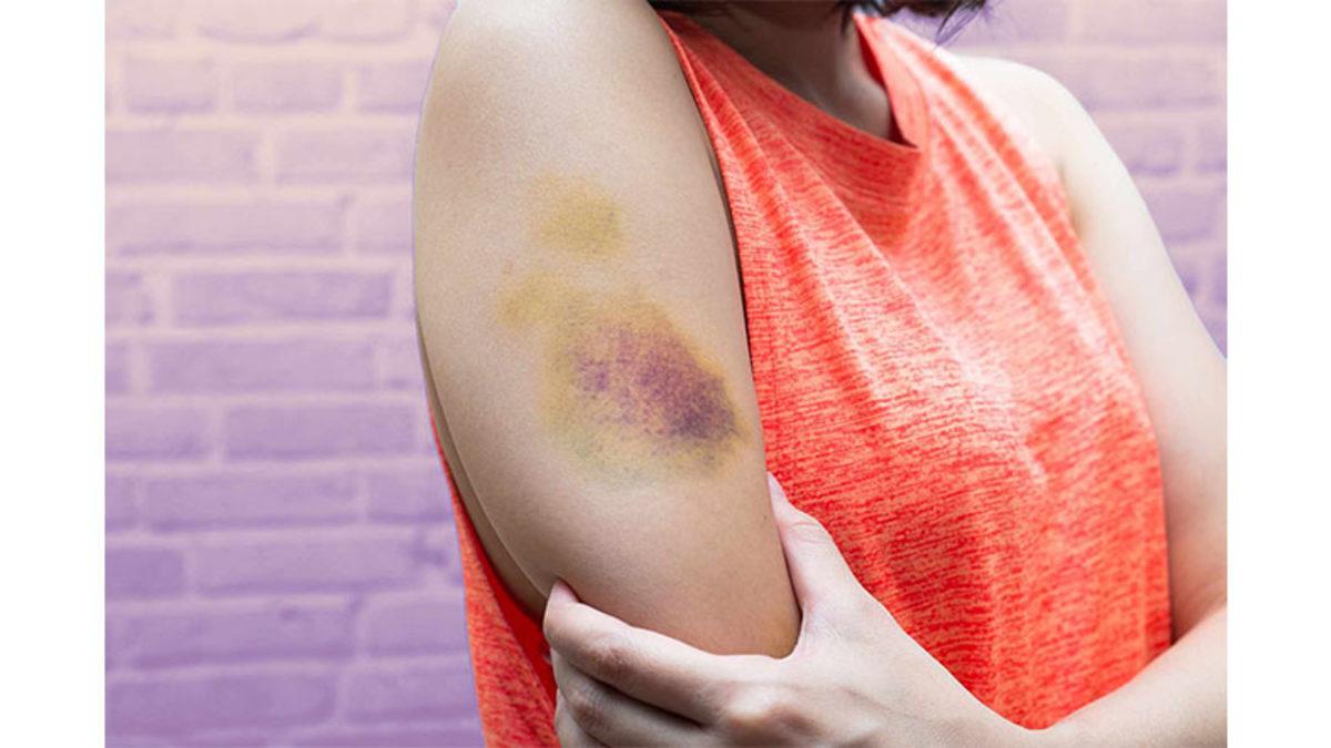 Cildimizdeki Morluklar İyileşirken Ortaya Farklı Renkler Çıkmasının Çok Mantıklı Sebebi