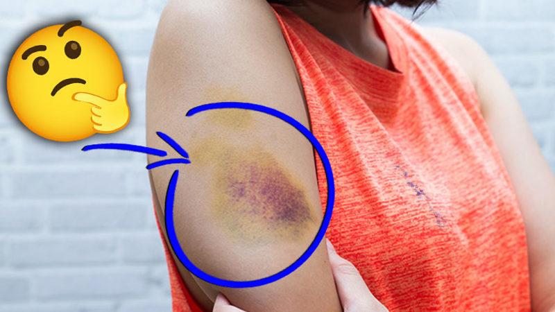Cildimizdeki Morluklar İyileşirken Ortaya Farklı Renkler Çıkmasının Çok Mantıklı Sebebi