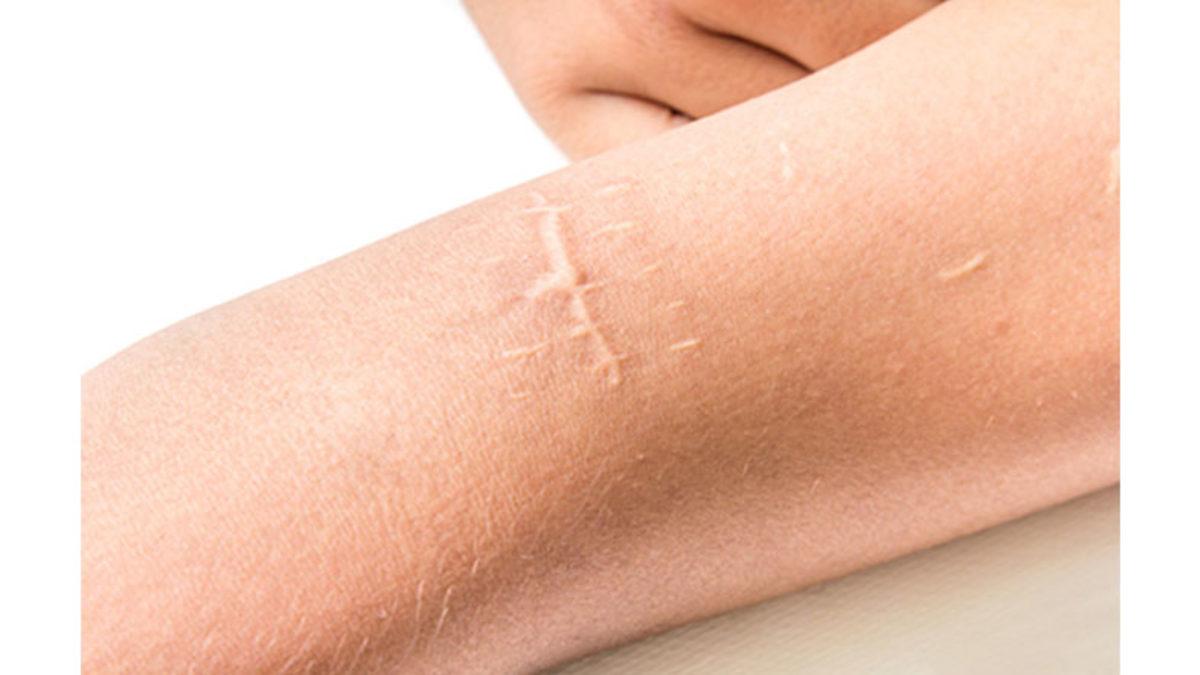 Vücudumuzdaki Bazı Yara İzleri Ne Yaparsak Yapalım Neden Hiç Geçmez?
