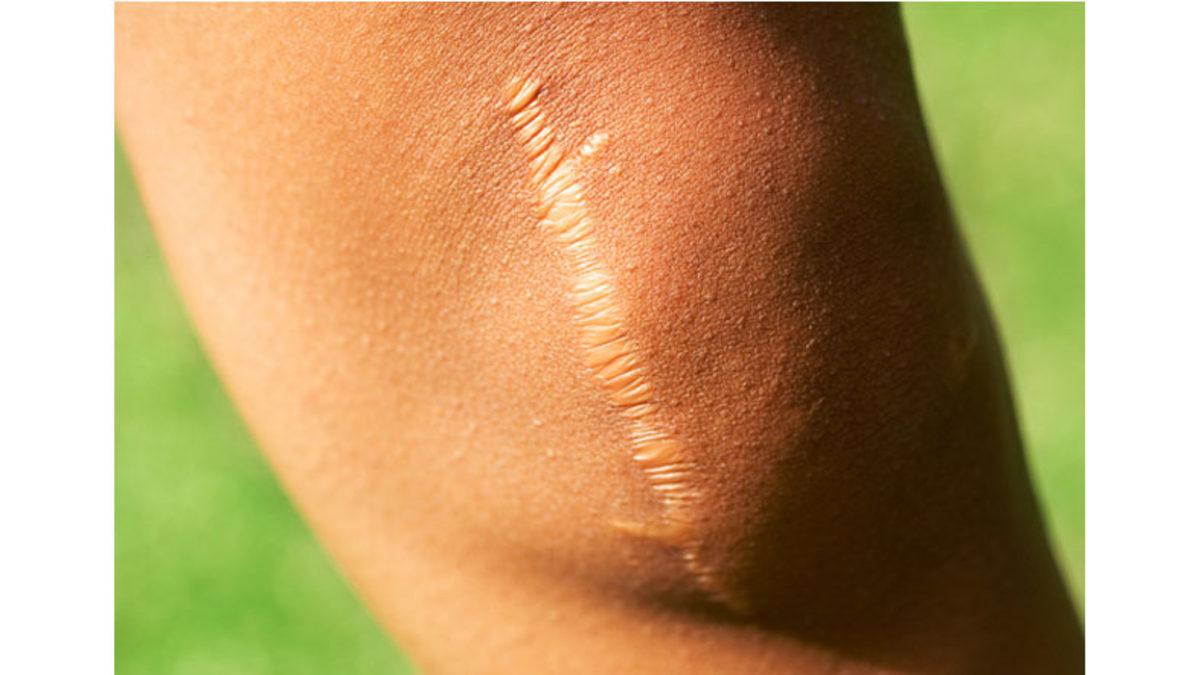 Vücudumuzdaki Bazı Yara İzleri Ne Yaparsak Yapalım Neden Hiç Geçmez?