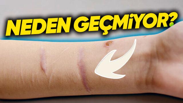 Vücudumuzdaki Bazı Yara İzleri Ne Yaparsak Yapalım Neden Hiç Geçmez?