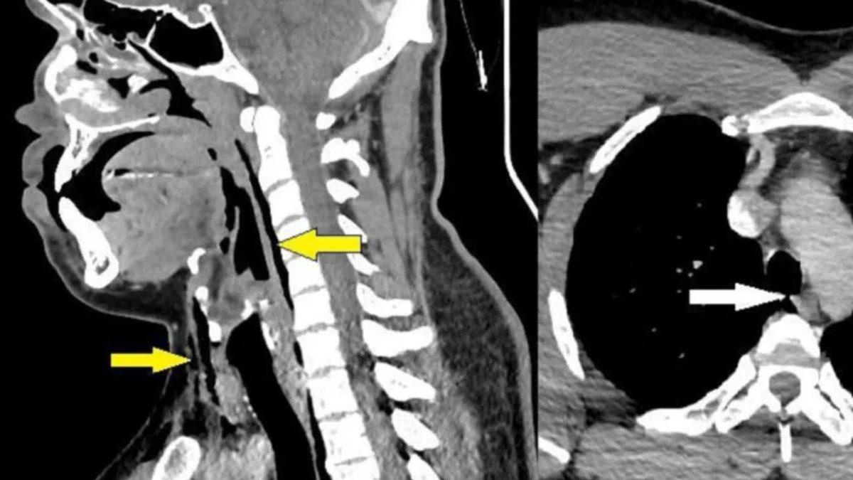 Hapşırığımızı Tuttuğumuz Zaman Başımıza Neler Gelebilir? Nefes Borusunda Yırtık Oluşan Bile Var!