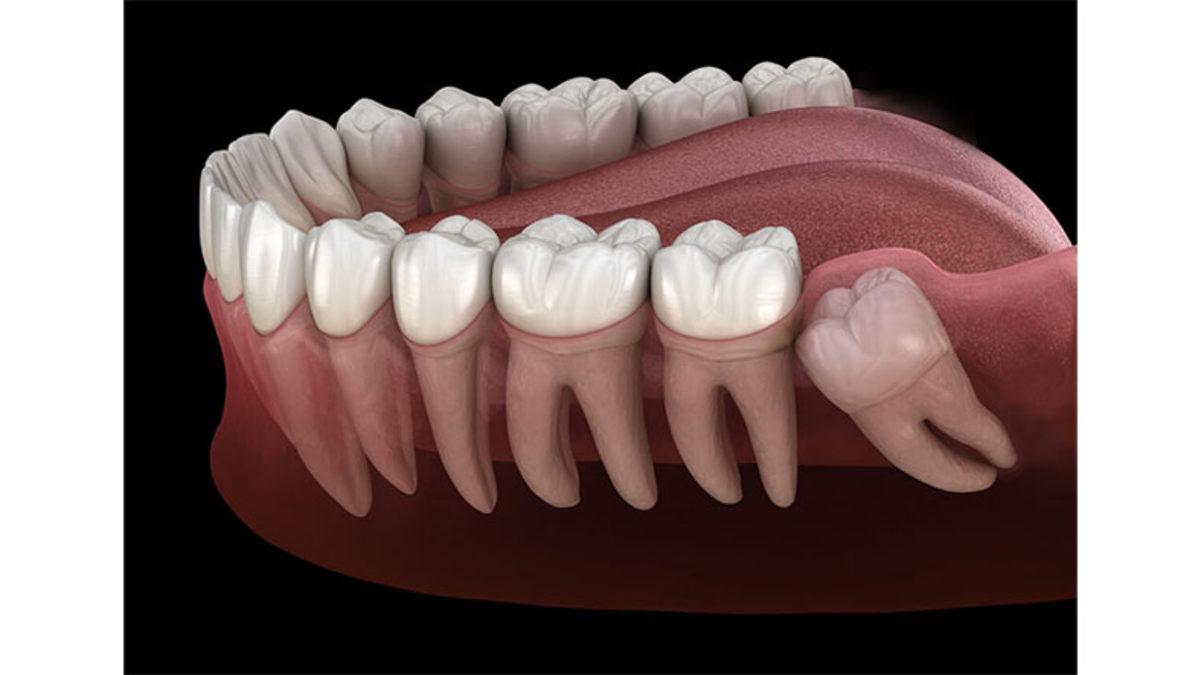 Yirmilik Dişlerin Genelde Yirmili Yaşlardan Sonra Çıkmasının Biraz Sinirinizi Bozacak Sebepleri