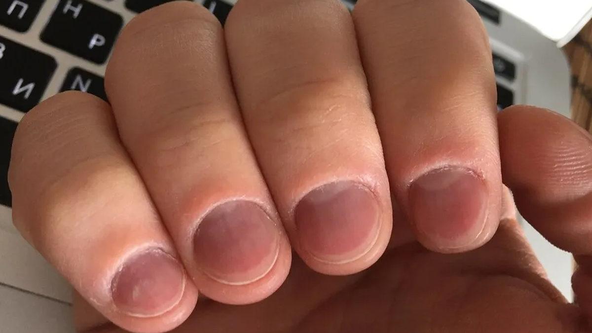 Stresliyken Neden Acısını Tırnaklarımızdan Çıkarıp Onları Koparıyoruz?