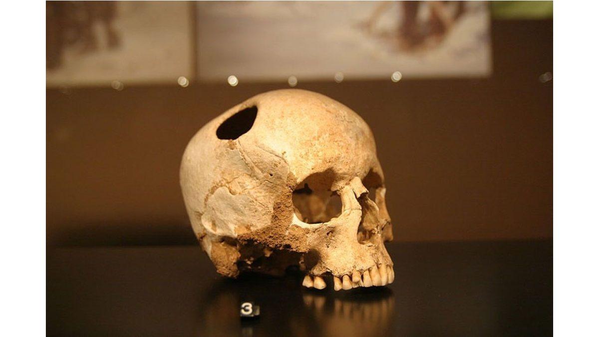 Eski Dönemlerde Neden İnsanların Kafasına Koca Koca Delikler Açılıyordu? (Günümüzde de Yapılabiliyor!)