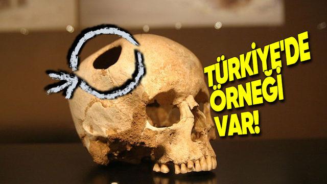 Eski Dönemlerde Neden İnsanların Kafasına Koca Koca Delikler Açılıyordu? (Günümüzde de Yapılabiliyor!)