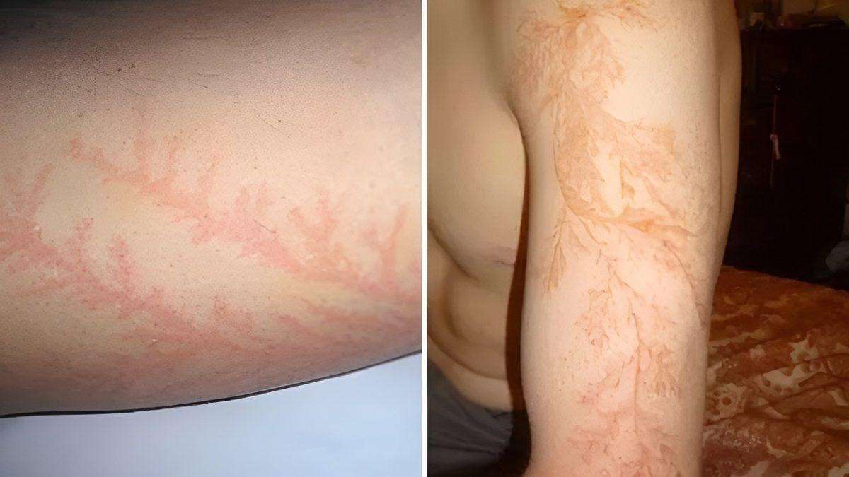 Bir İnsana Yıldırım Çarptığı Zaman Vücudunda Neler Olur? Psikolojik Etkileri Bile Varmış!