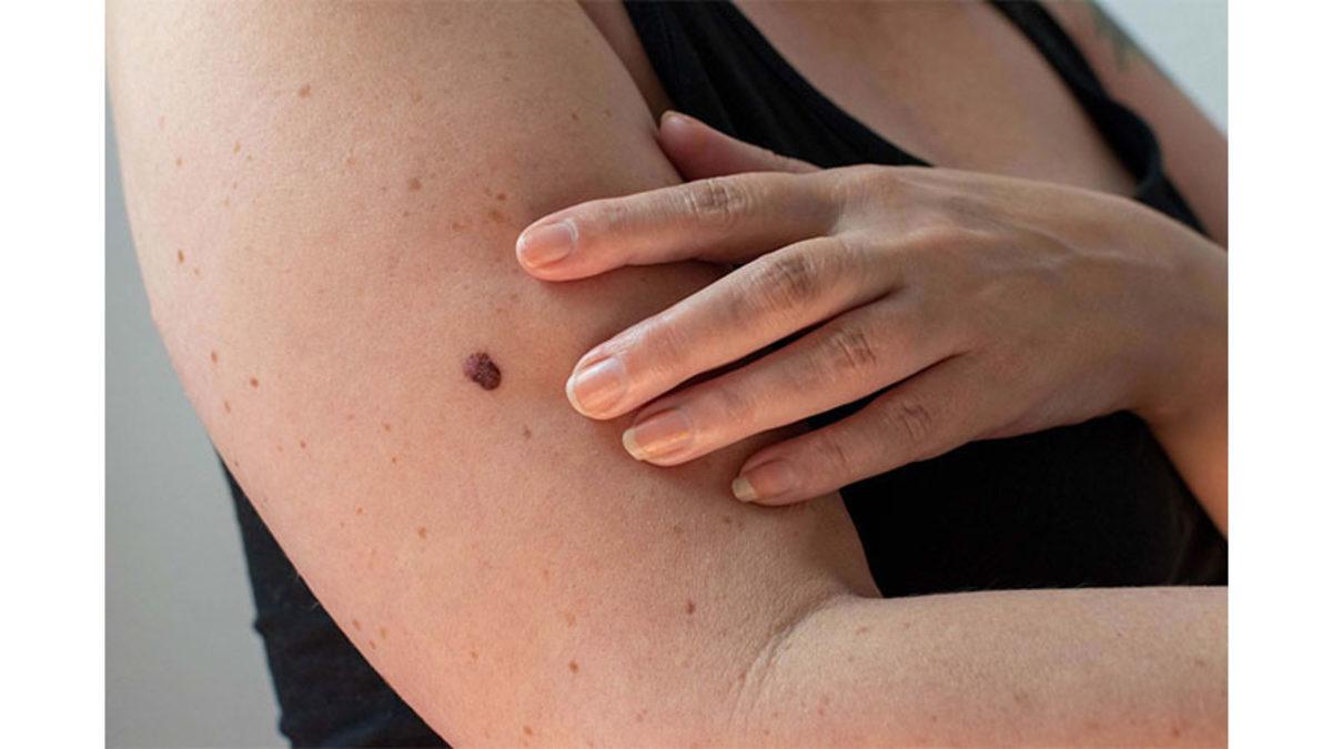 Herkesin Vücudunda Çeşit Çeşit Olan Benler Neden ve Nasıl Oluşuyor?