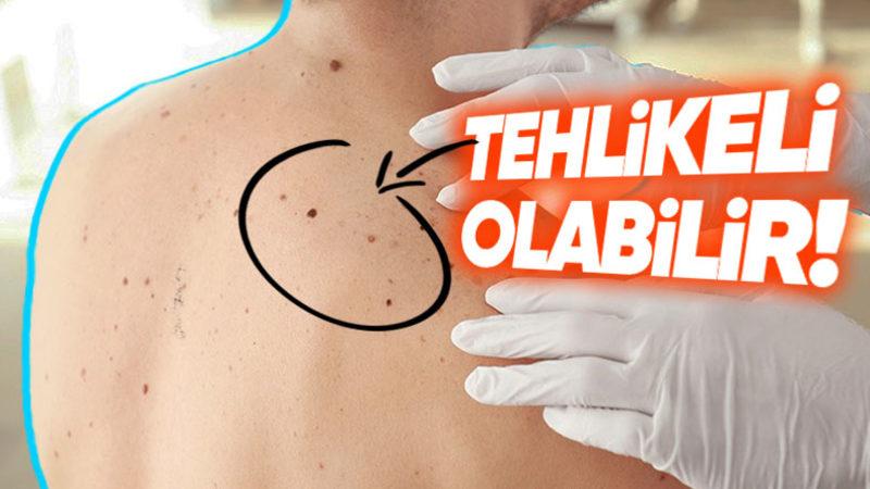 Herkesin Vücudunda Çeşit Çeşit Olan Benler Neden ve Nasıl Oluşuyor?