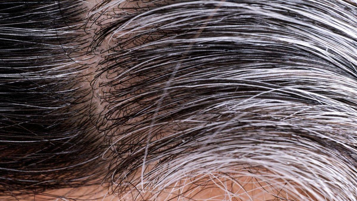 Stres Gerçekten Saç Beyazlatır mı, Yoksa Bu Bir Şehir Efsanesi mi?