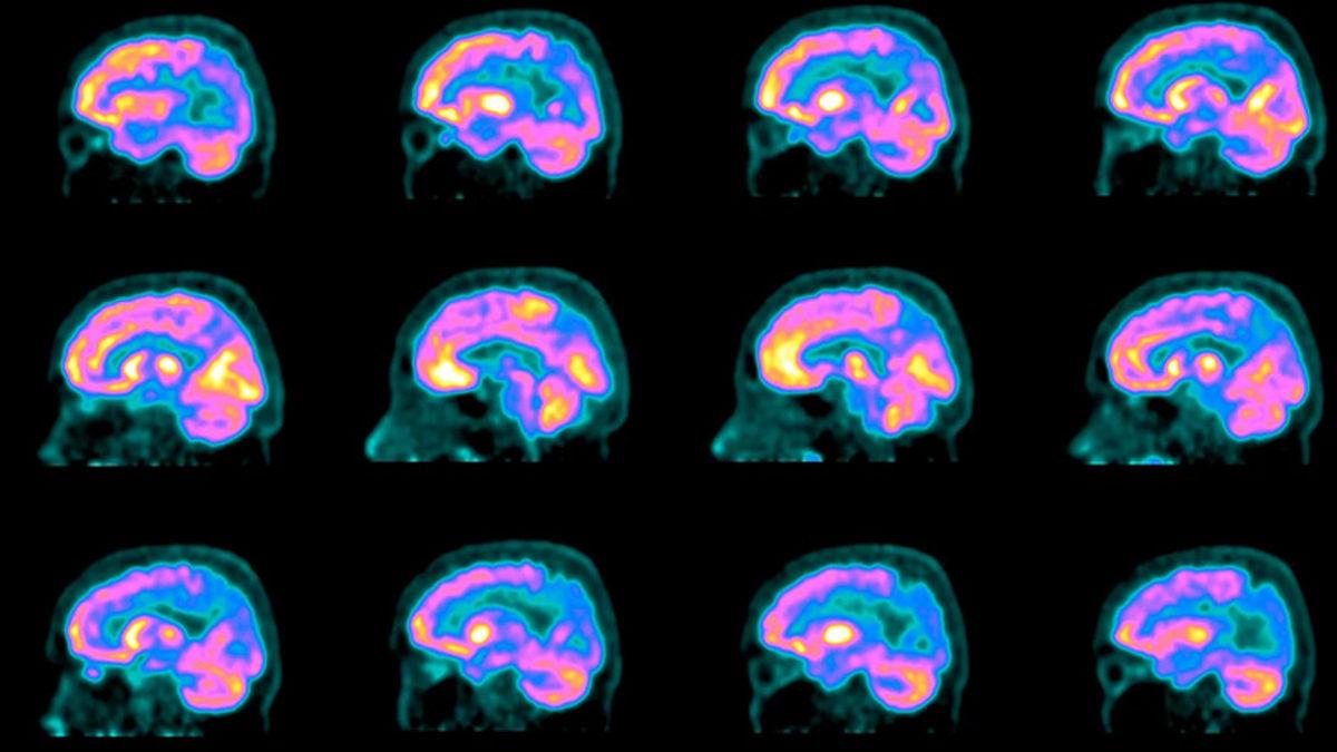 Eski Zamanlardan Beri Karşımıza Çıkan Alzheimer’ın Neden Günümüzde Hâlâ Bir Tedavisi Yok?