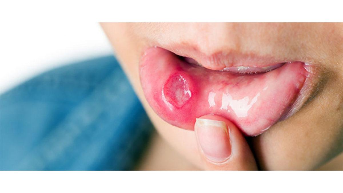 Vücudumuzun Herhangi Bir Yerindeki Yaralar Hemen İltihaplanırken Ağızda Oluşan Yaralar Neden İltihaplanmıyor?
