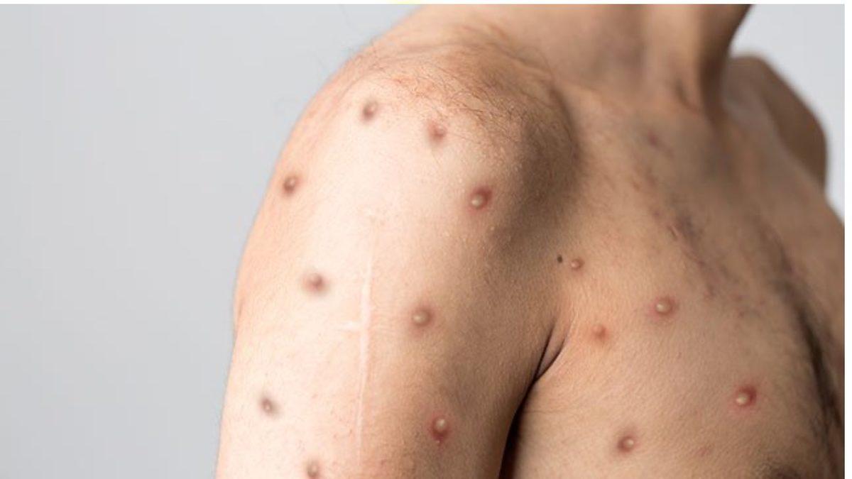 ’Maymun Çiçeği’ Diye Bir Bitki Olmamasına Rağmen Neden Virüse ’Maymun Çiçeği’ Deniyor?