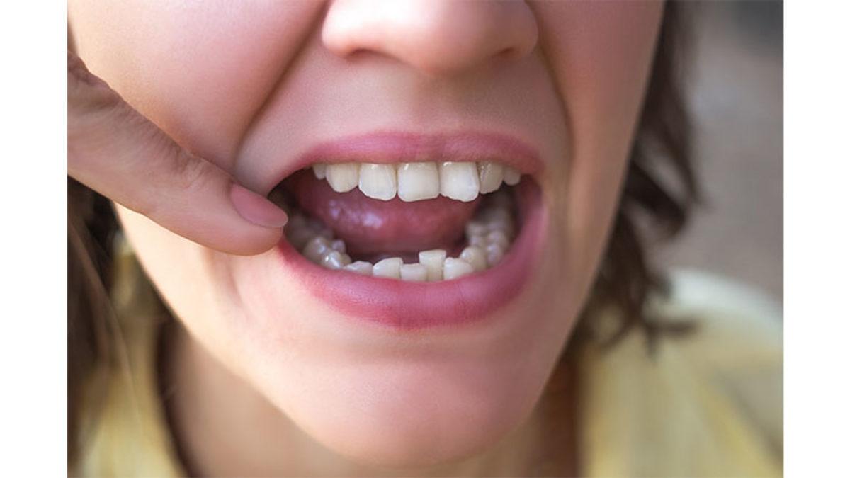 Vücudumuzun Herhangi Bir Yeri Kendi Kendini İyileştirebiliyorken Dişlerimiz İçin Neden Bir Müdahale Gerekiyor?