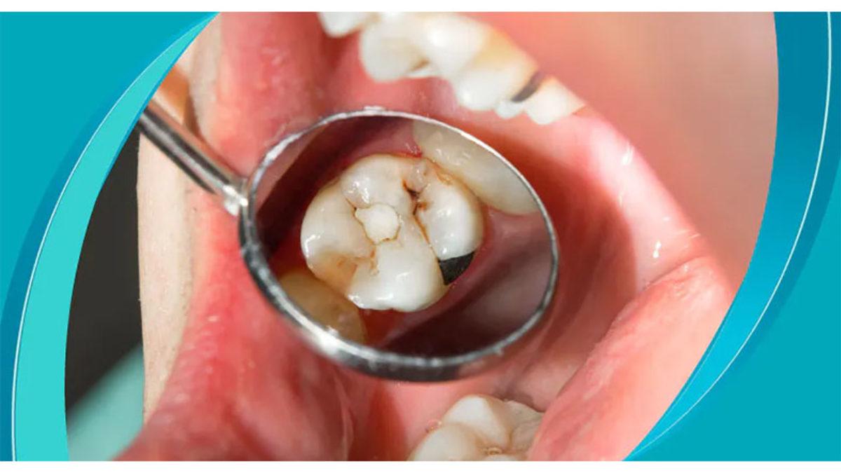 Vücudumuzun Herhangi Bir Yeri Kendi Kendini İyileştirebiliyorken Dişlerimiz İçin Neden Bir Müdahale Gerekiyor?