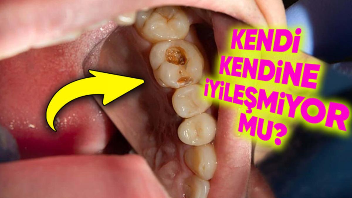 Vücudumuzun Herhangi Bir Yeri Kendi Kendini İyileştirebiliyorken Dişlerimiz İçin Neden Bir Müdahale Gerekiyor?