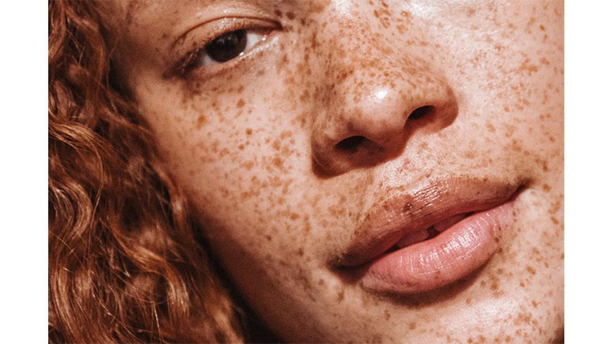 Çiller Nasıl Oluşuyor, Niye Her İnsanda Olmuyor?