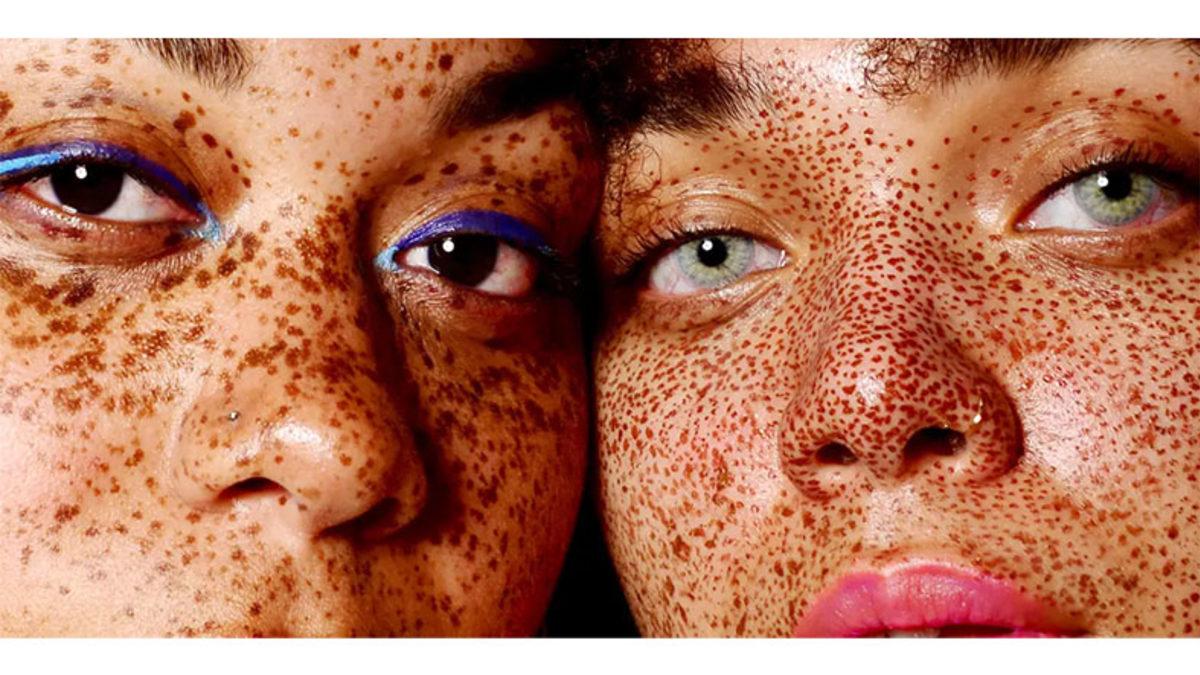 Çiller Nasıl Oluşuyor, Niye Her İnsanda Olmuyor?