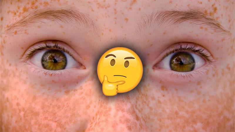 Çiller Nasıl Oluşuyor, Niye Her İnsanda Olmuyor?