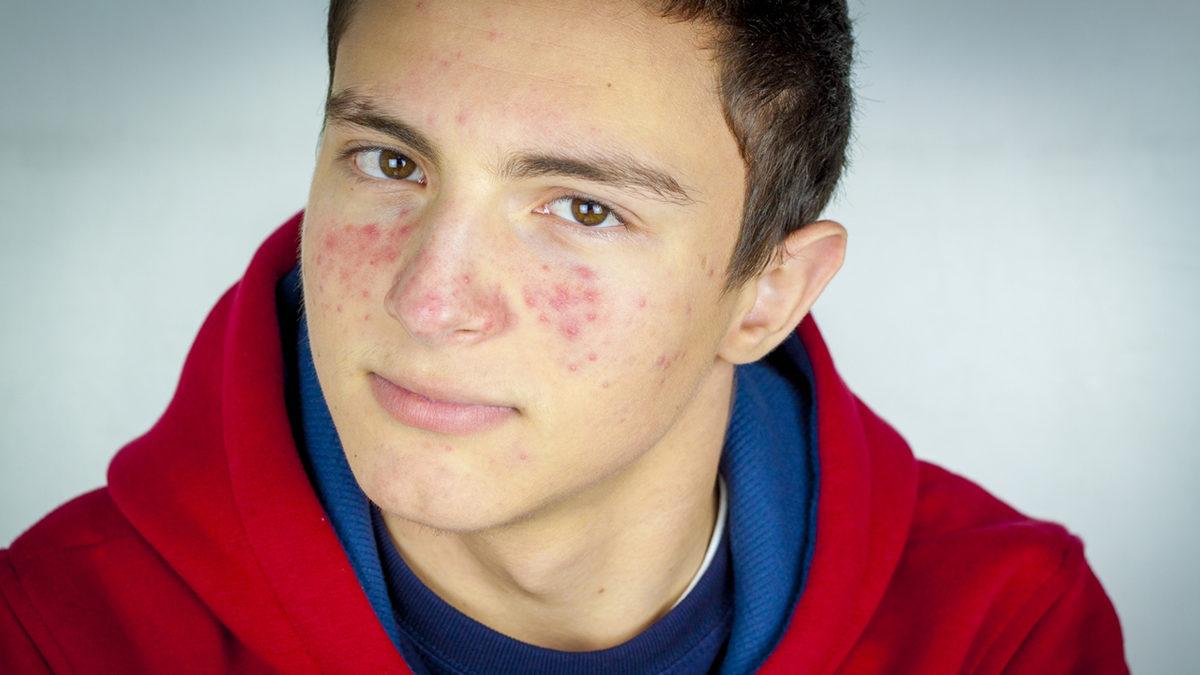 Ergenlerin Canını Sıkan Sivilceler Neden Gençliğin En Güzel Dönemlerinde Baş Belası Hâline Geliyor?