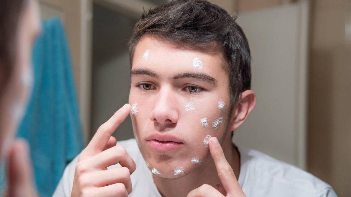 Ergenlerin Canını Sıkan Sivilceler Neden Gençliğin En Güzel Dönemlerinde Baş Belası Hâline Geliyor?