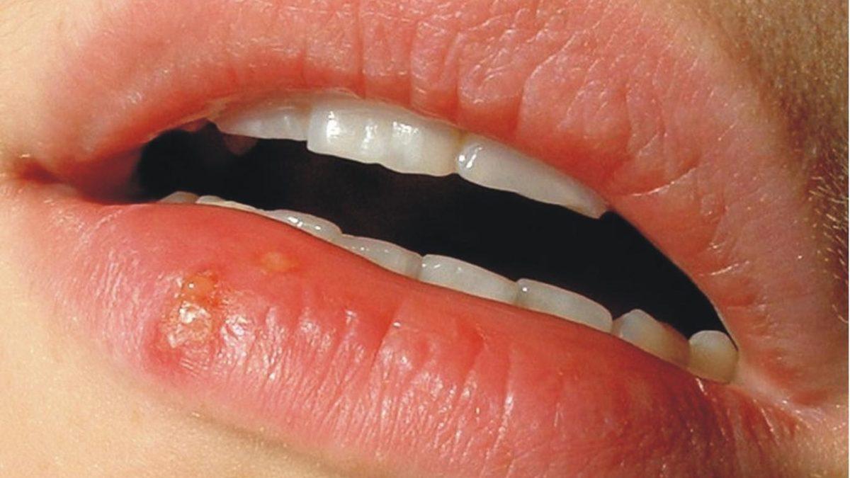 Stresliyken Niye Uçuk Çıkartıyoruz? Vücudunuzda Haberiniz Olmayan Bir Şey Sinsice Aktive Oluyor!