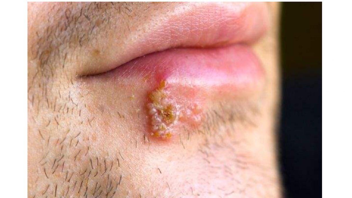 Stresliyken Niye Uçuk Çıkartıyoruz? Vücudunuzda Haberiniz Olmayan Bir Şey Sinsice Aktive Oluyor!