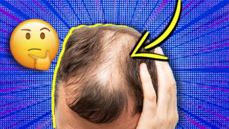 Kelleşme Neden Arkadan Değil de Tepeden Oluyor? Kadınlarda Böyle Bir Kelleşme Olmamasının Sebebi de Aynı!