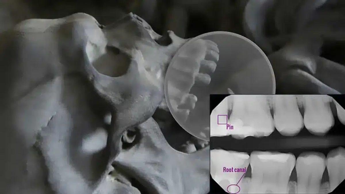 Kayıp Narin Olayı Diş İzinden Çözülür mü, Tıpkı Parmak İzinde Olduğu Gibi Diş İzimizden de Kimlik Tespit Edilir mi? İşte Bilimin Cevabı