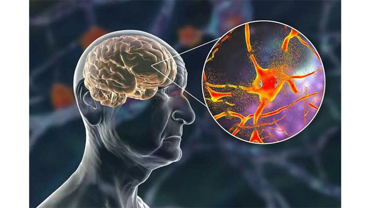 Hafızasını Kaybeden Kişiler Yediği Yemeği Bile Unutuyorken Nasıl Oluyor da Konuştukları Dili Unutmuyorlar?