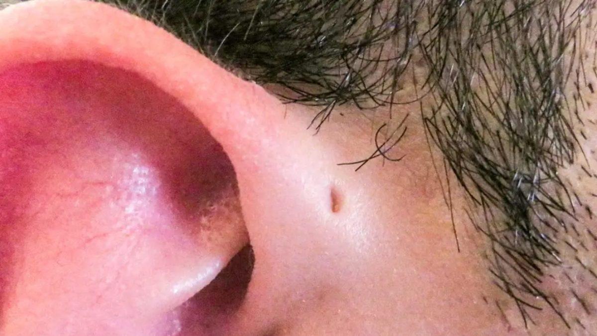 Bazılarımızın Kulağının Yanındaki Bu Minik İz Neyin Nesi? Piercing İzi Falan Değil!