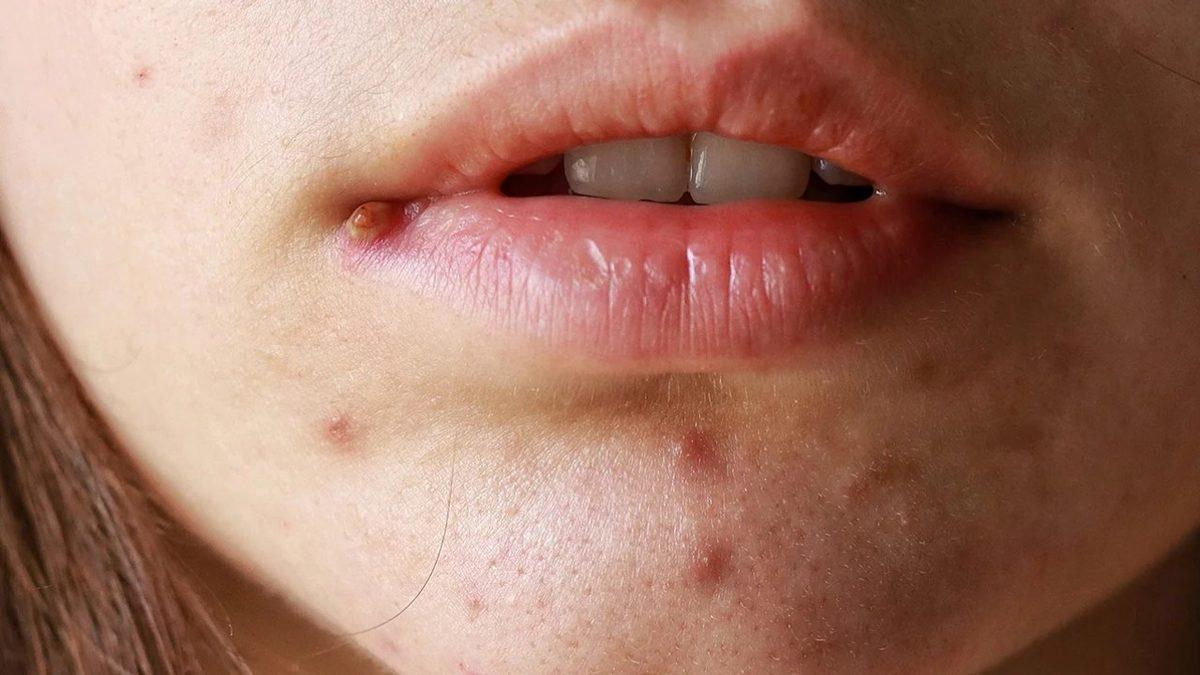 Sivilcelerinizi Patlatınca Cildinizde Neler Olduğunu Öğrenince Onlara Bir Daha Dokunmak İstemeyeceksiniz!