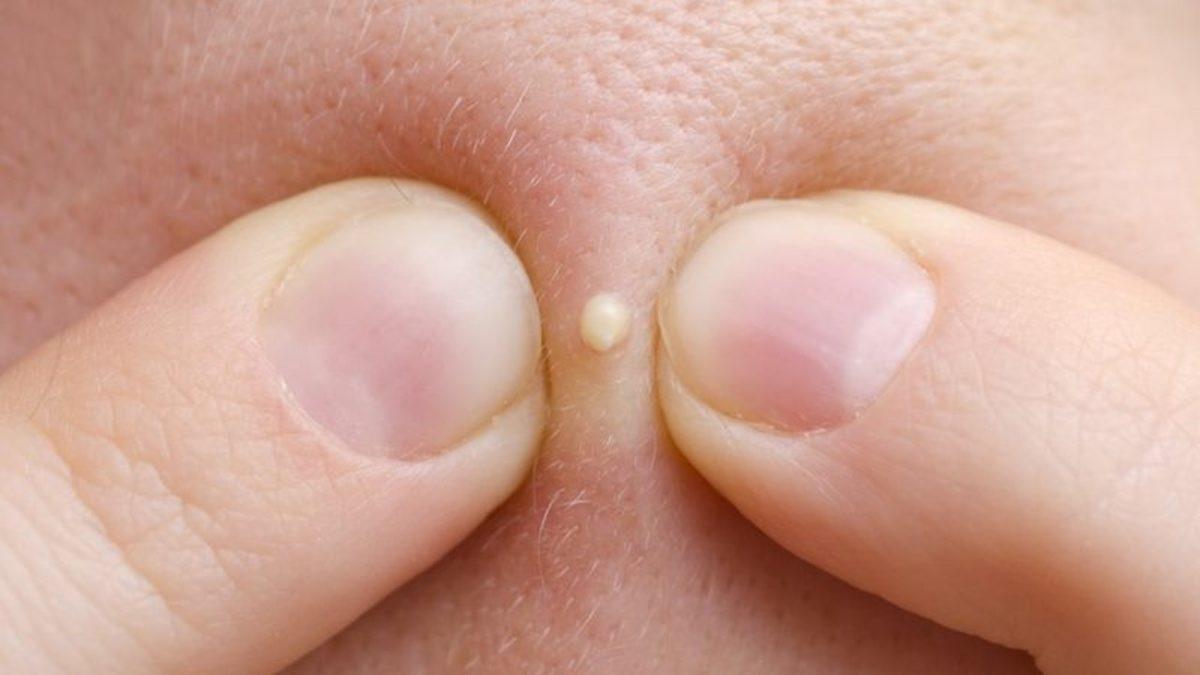 Sivilcelerinizi Patlatınca Cildinizde Neler Olduğunu Öğrenince Onlara Bir Daha Dokunmak İstemeyeceksiniz!