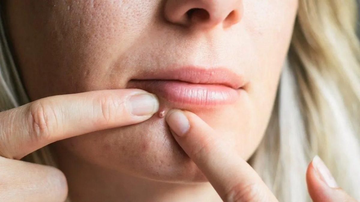 Sivilcelerinizi Patlatınca Cildinizde Neler Olduğunu Öğrenince Onlara Bir Daha Dokunmak İstemeyeceksiniz!