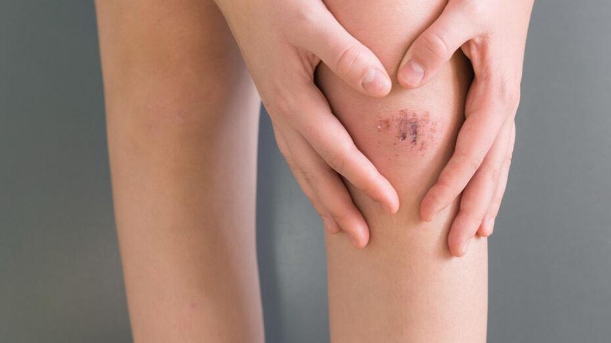 Küçük Yara ve Kesikleri İyileştirmede Yara Bandı mı Yoksa Açık Bırakmak mı Daha Etkili?