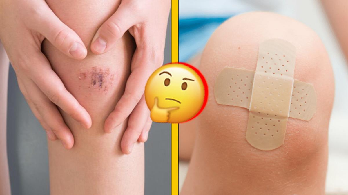 Küçük Yara ve Kesikleri İyileştirmede Yara Bandı mı Yoksa Açık Bırakmak mı Daha Etkili?