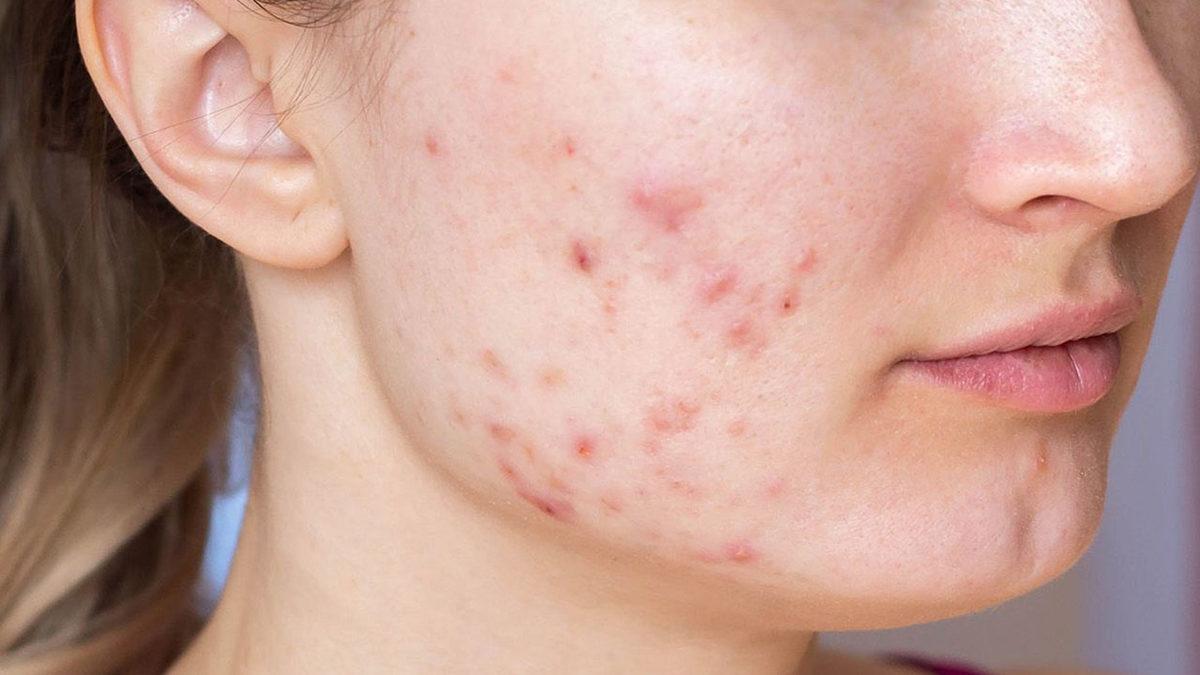 TikTok Fenomenlerinin Sivilce Sorunu İçin Verdikleri Tavsiye, Deli Saçması Çıktı: Kansere Yol Açıyor