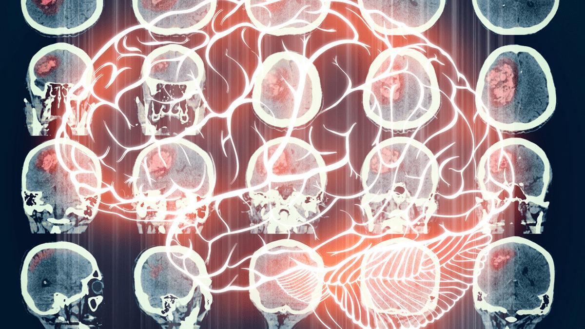 Bilim İnsanlarını Şaşkına Çeviren, Dünyanın En Genç Alzheimer Olan İnsanı Nasıl 19 Yaşında Bu Hastalığa Yakalandı?