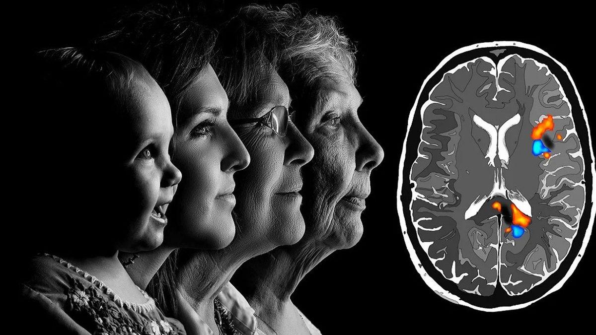 Bilim İnsanlarını Şaşkına Çeviren, Dünyanın En Genç Alzheimer Olan İnsanı Nasıl 19 Yaşında Bu Hastalığa Yakalandı?